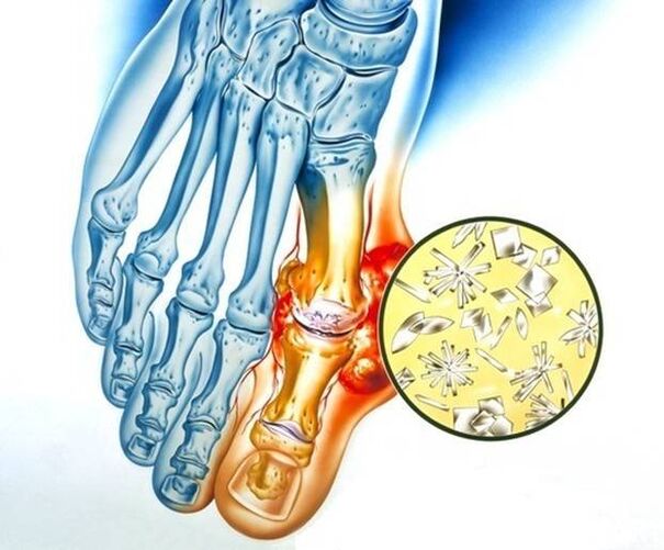 Deposição de urato na gota, causando inflamação na articulação